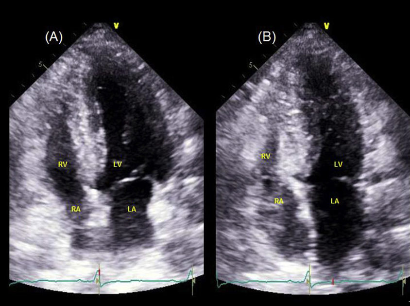 Comparison of 4CH view at end of diastole and end of systole.